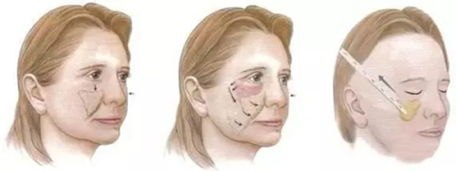 五、如何让纳米双眼皮维持更久