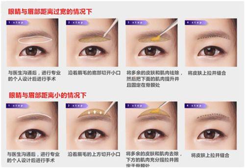 线雕隆鼻有没有危害？操作、材料、护理不当存风险，后遗症弊端需警惕