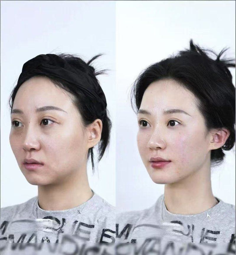 五、线提升隆鼻的常见弊端与后遗症汇总