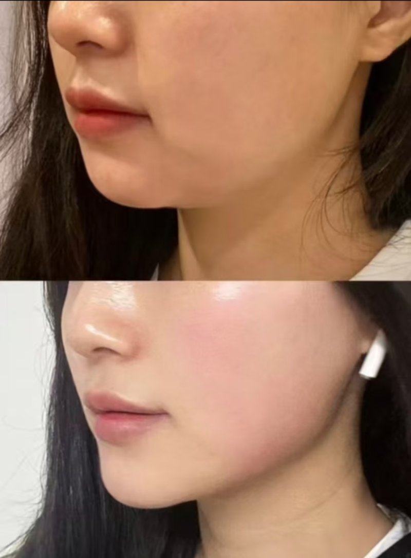 二、纳米无痕双眼皮的本质：埋线术式的“包装噱头”