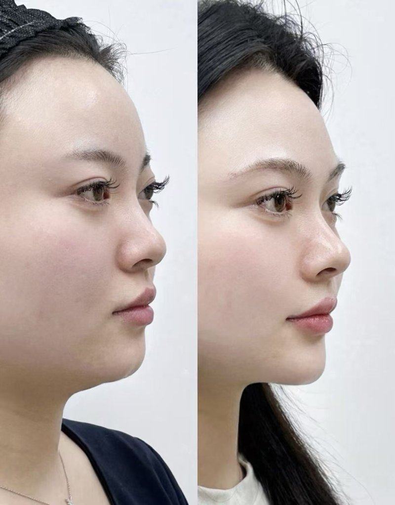 三、腿部抽脂的长期危害：哪些后遗症会影响未来状态