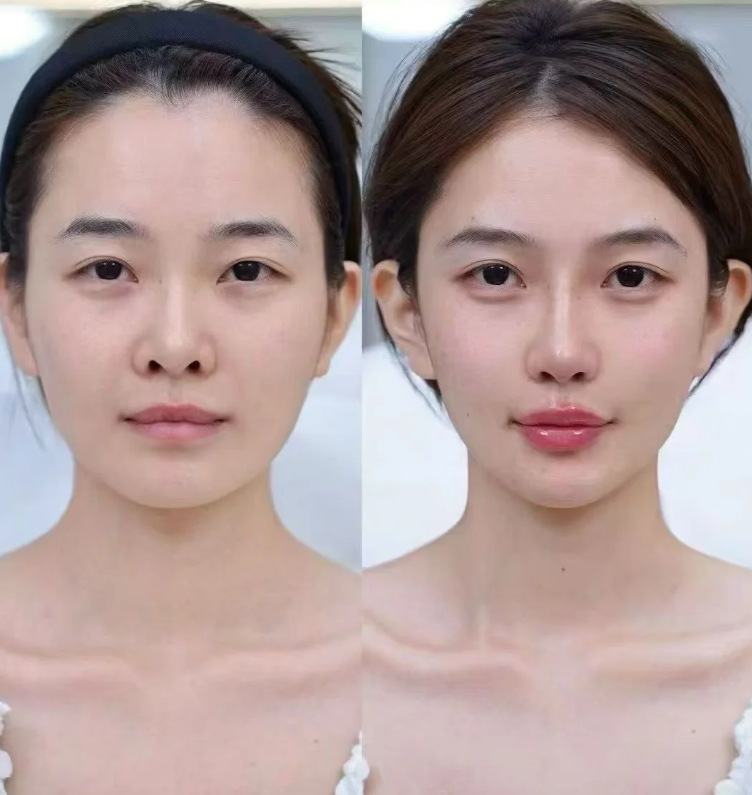 五、内切去眼袋后眼周凹陷松弛怎么办？填充+紧致双管齐下