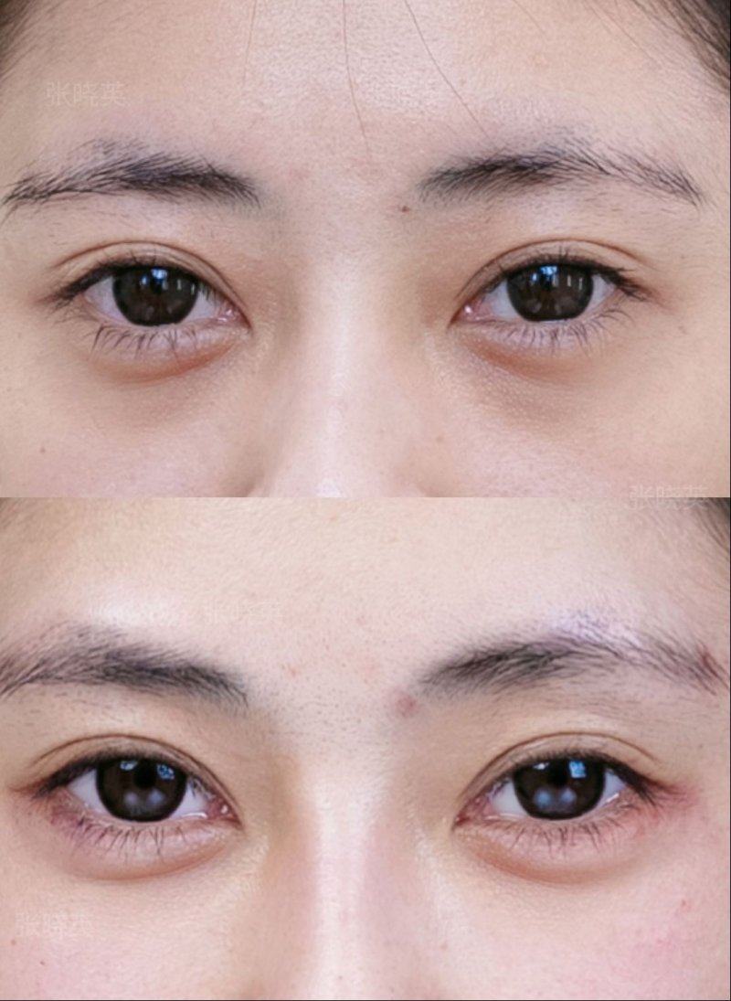 五、抽脂过量的风险：别盲目追求大抽取量