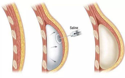 四、如何去除脸上的眼袋更有效，手术方案精细解决中重度眼袋