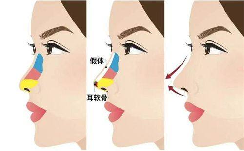 三、常规补打场景下，瘦脸针多久打第二次成效至佳