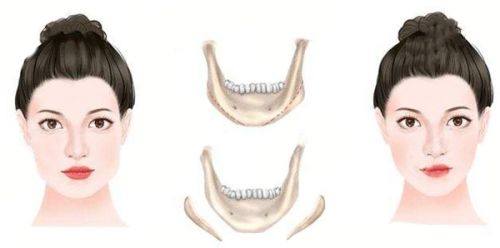 四、假体隆胸取出术后的绷带佩戴时长