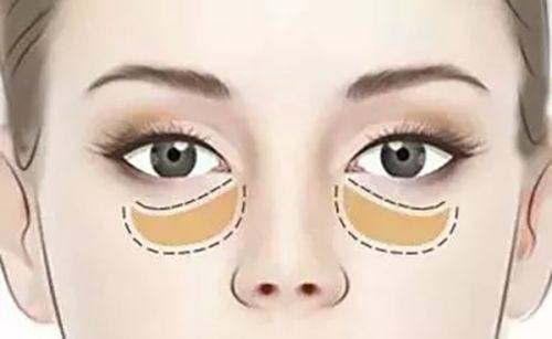三、如何去除脸上的眼袋和皱纹，针对性解决衰老问题
