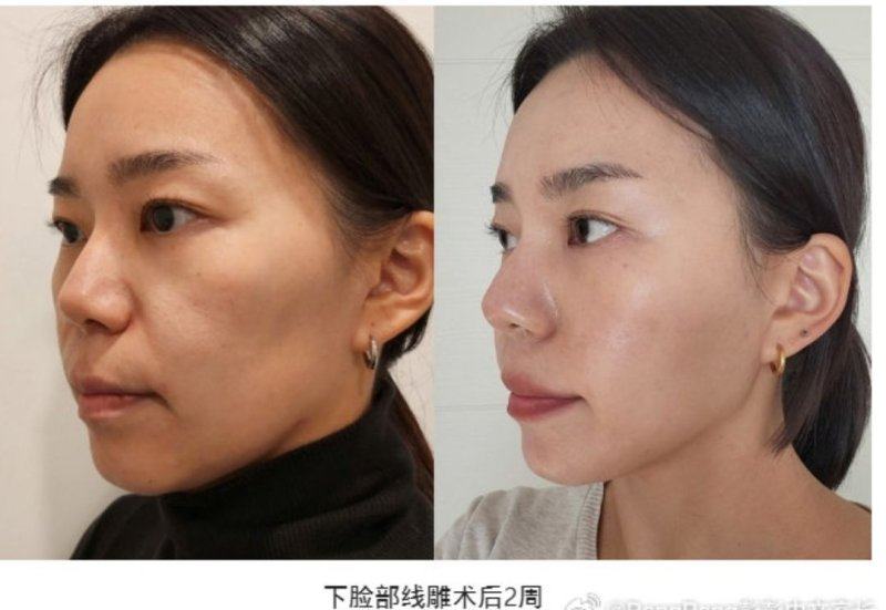 四、特殊状况下的补打间隔：以“蛙腮”为例