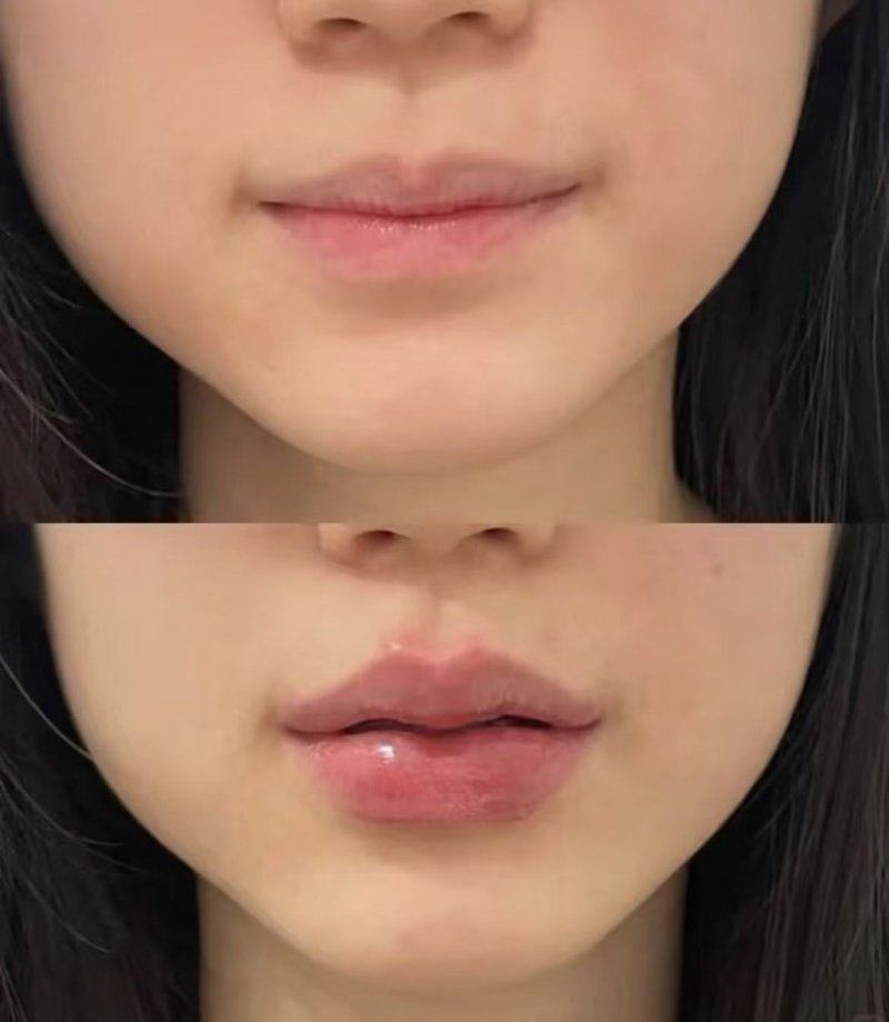 四、为啥打完瘦脸针一点感觉都没有的具体原因