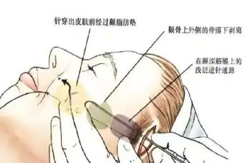 三、选对隆胸植入层次，降低哺乳风险