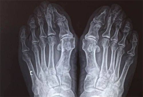 四、特殊类型烫伤疤痕的消除方法