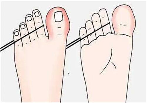 二、埋线双眼皮的优缺点深度解析