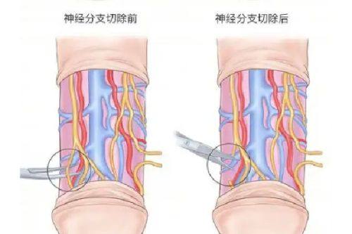 四、憩室小、无生育计划：宫腔镜手术改善症状