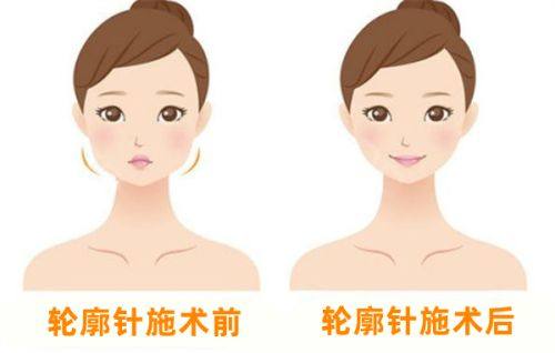 三、症状较轻或暂不适合手术：药物治疗缓解不适