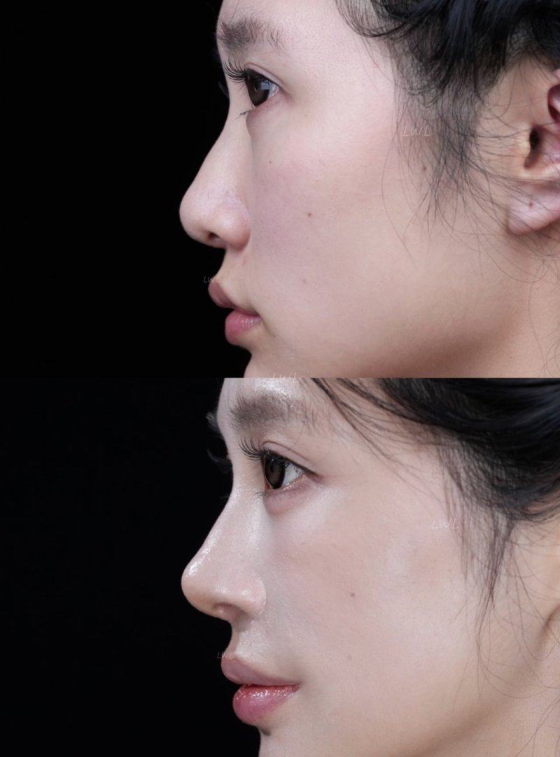 四、疤痕色素改善的核心：专精术后管理不可少