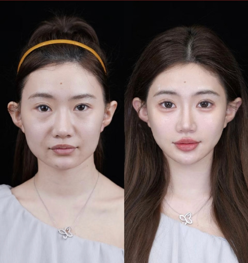 五、隆鼻手术的风险到底大吗？如何有效规避