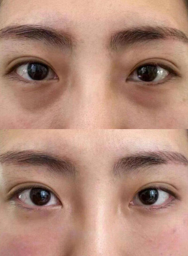 隆鼻手术有什么危险吗？技术成熟仍存风险，不同隆鼻方式隐患各有差异