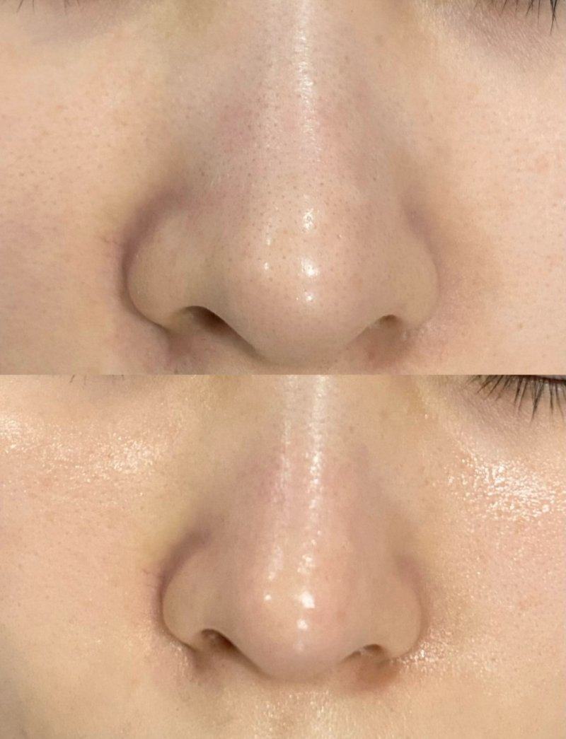 从缝合源头预防缝线疤痕：精细化减张与隐蔽设计