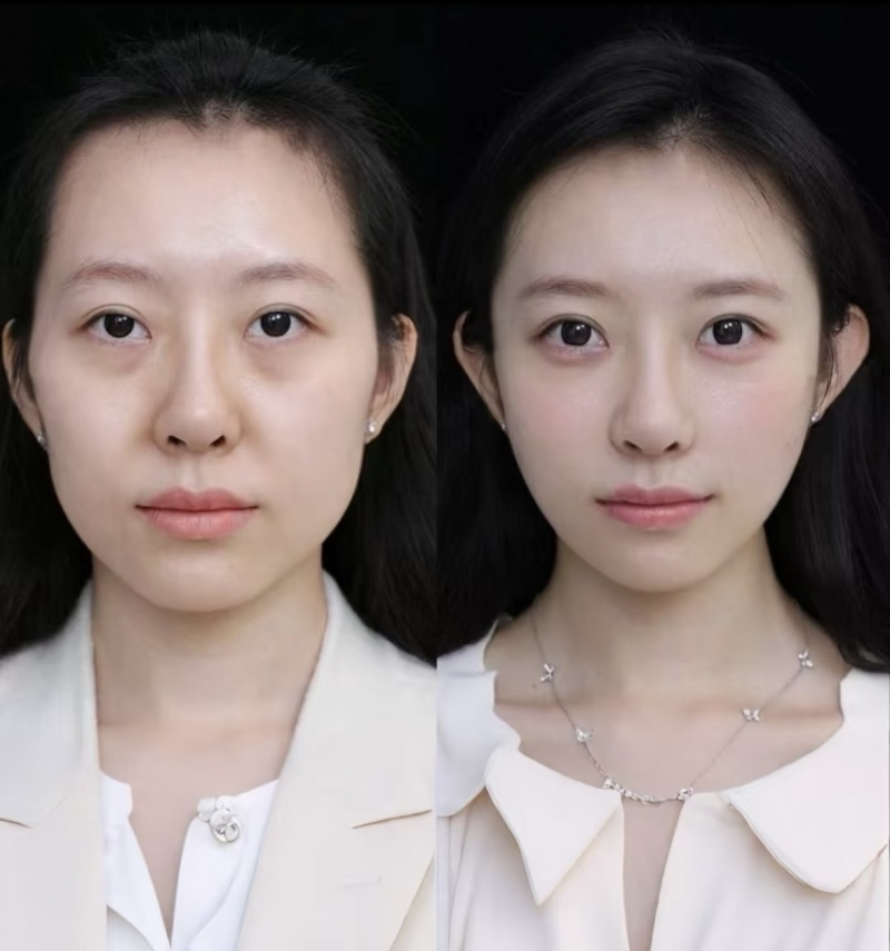 三、中重度眼袋的手术类良好选择