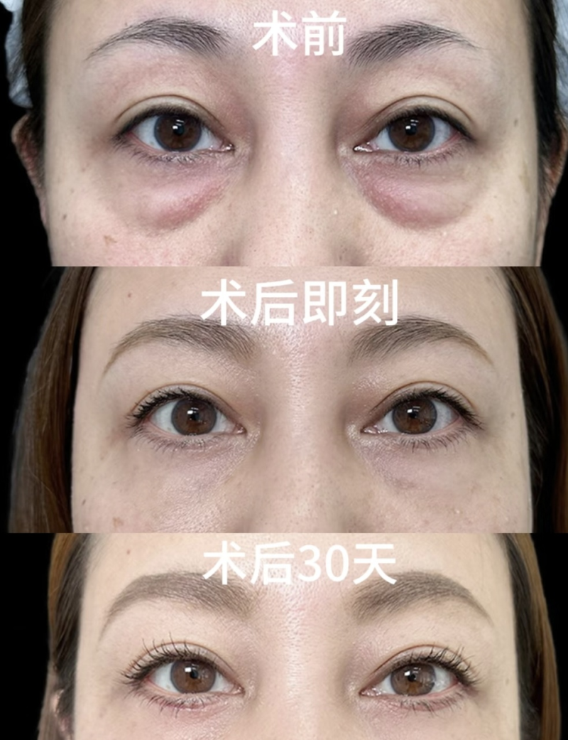 五、具有影响力骨干医生对儿童下眼袋发黑的补充观点