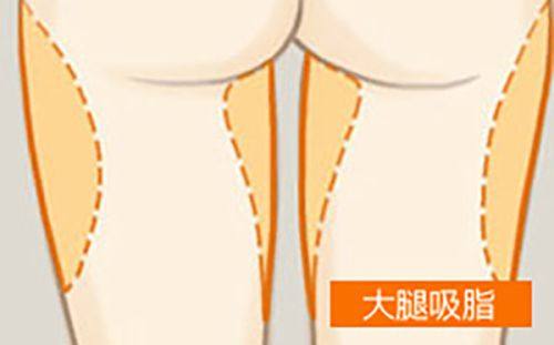 三、外切去眼袋术后，疤痕膏的正确打开方式