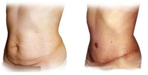 如何降低年轻人祛眼袋后的复发率