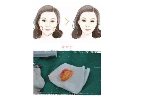 按眼袋类型精细选术式（附2025价格参考）