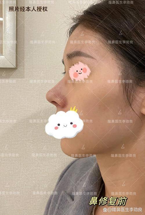 韩国崔寓植Noselips整形外科价格表