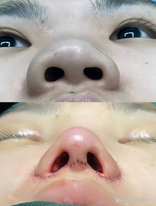 韩国崔寓植Noselips整形外科擅长项目