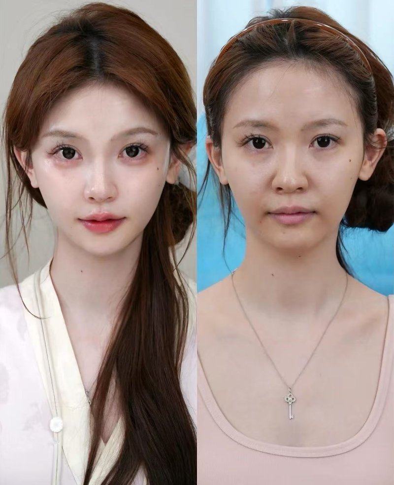 五、割的双眼皮能修复回原来的样子吗