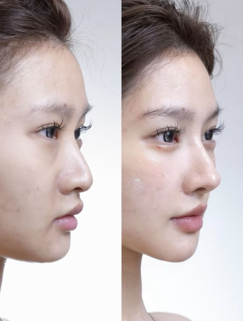 二、疤痕膏为何无法解决眼袋根源问题