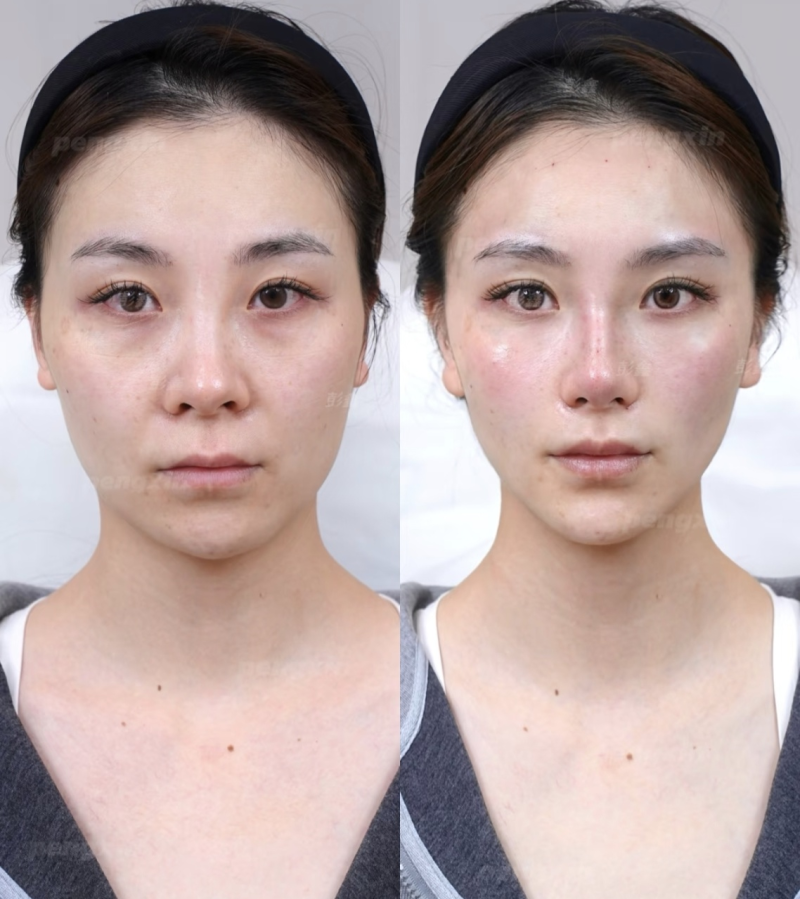 三、耳软骨隆鼻多长时间修复正常