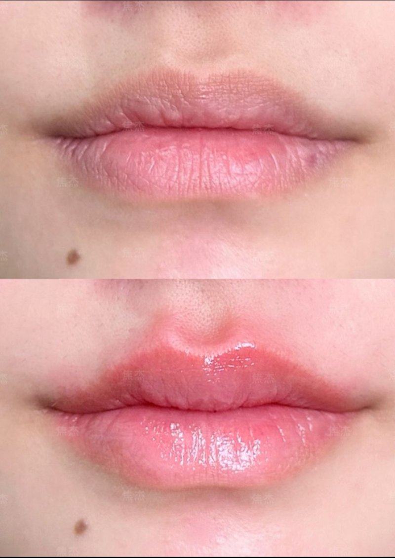 三、双眼皮修复的关键注意事项