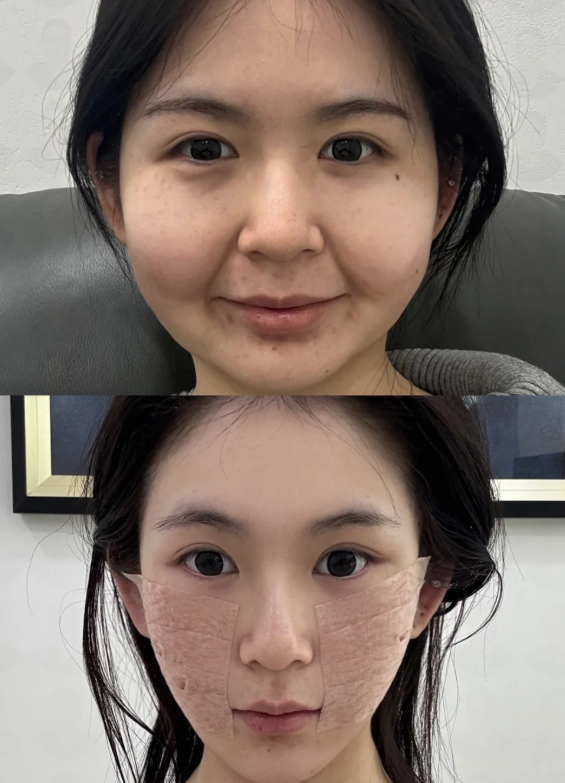 年轻人祛眼袋术后修复指南