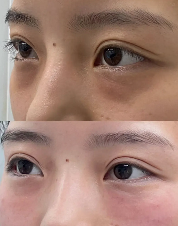 二、去眼袋和黑眼圈的日常小妙招（轻中度适用）