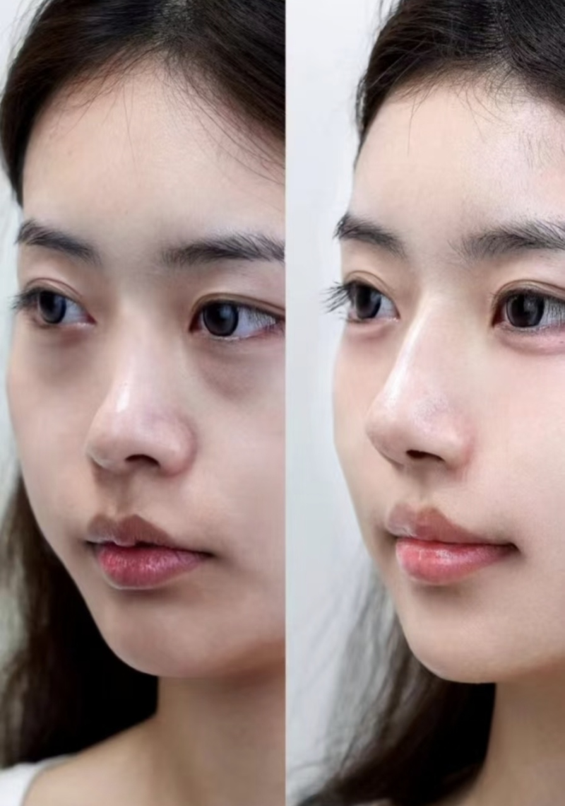 五、眼袋修复术后，疤痕膏的特殊价值