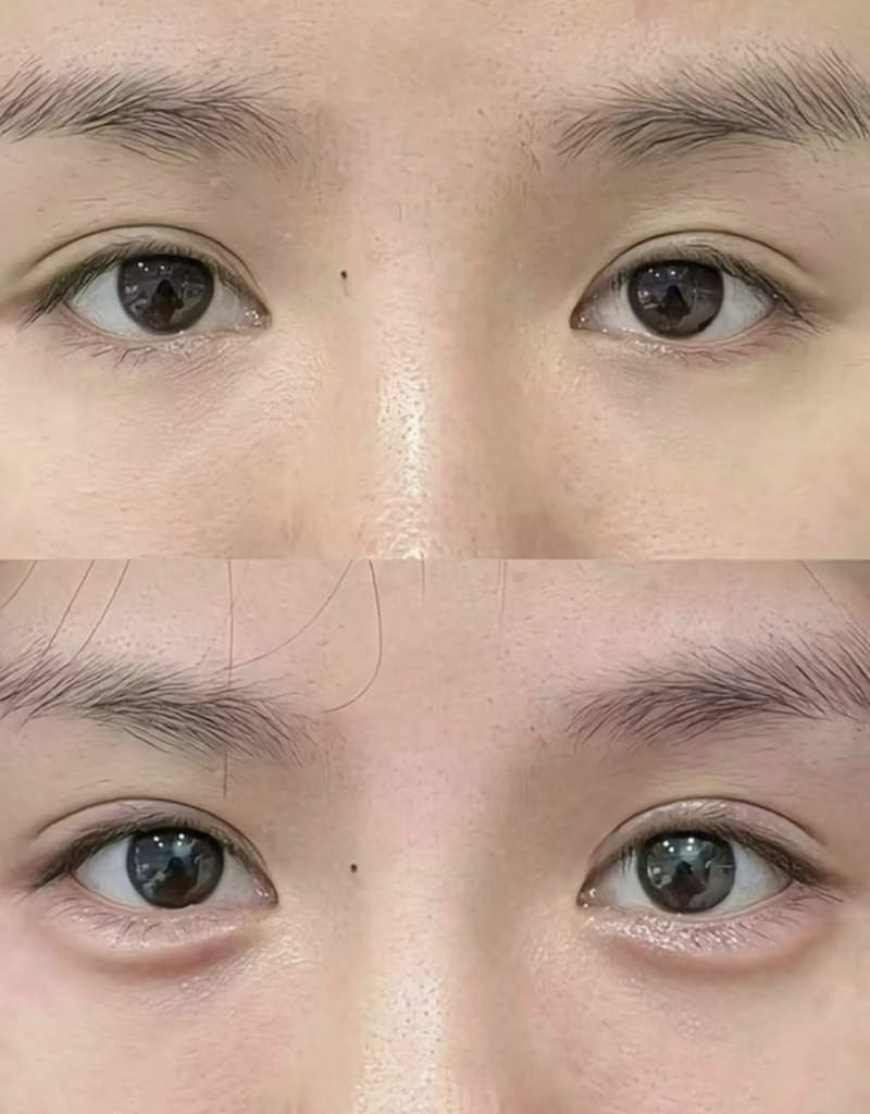 二、耳软骨隆鼻手术时长细节解析