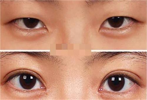 术后皮肤量不足的特殊修复策略