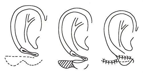 三、单眼皮变双眼皮的常见实现方式及适配方案