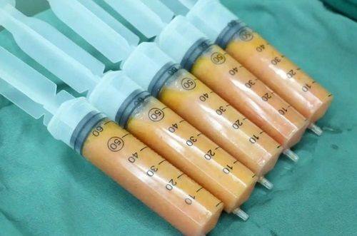 三、维生素e去眼袋的成效解析