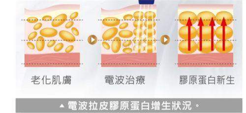 五、单眼皮与双眼皮的利弊对比及避坑指南