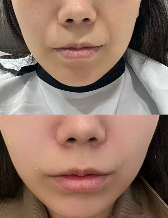 二、单眼皮贴双眼皮贴久了会变双眼皮吗？