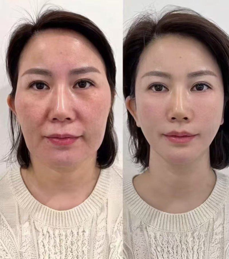 多眼皮修复推荐医生及术后护理要点