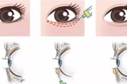 五、打了瘦咬肌的针后多久会消肿