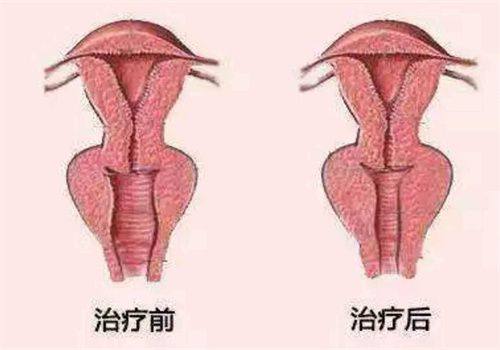 三、瘦脸针的成效维持时长与各阶段注意事项