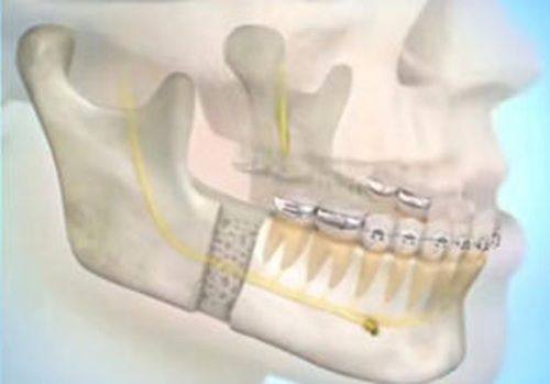 三、忆辰莱去眼袋真实评价