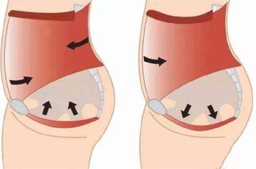 五、假体隆胸术后坐立及活动的核心注意事项