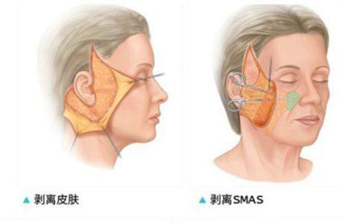 三、这些情况超肋隆鼻可以不用耳软骨