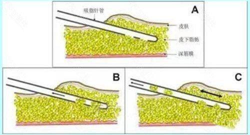 四、超肋鼻综合需要取耳软骨吗