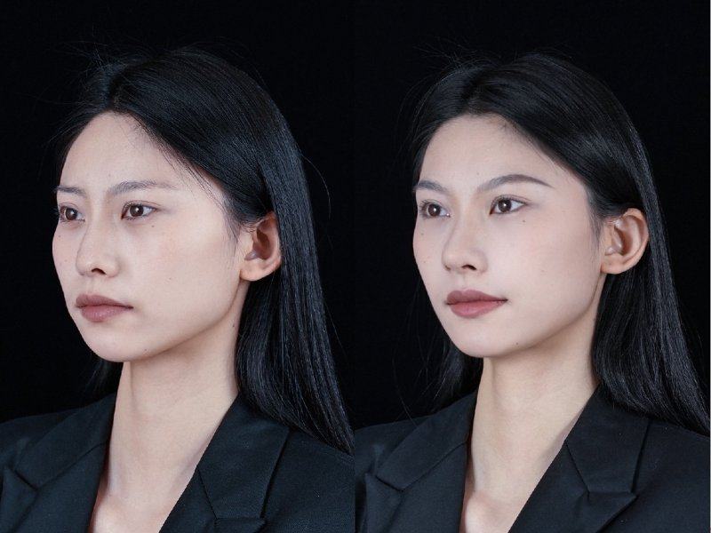 五、避开这些误区,才能不拉长抽脂修复期